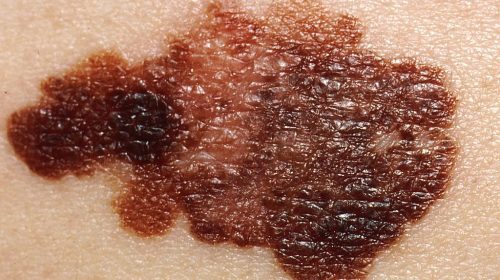 melanoma screening skin checks