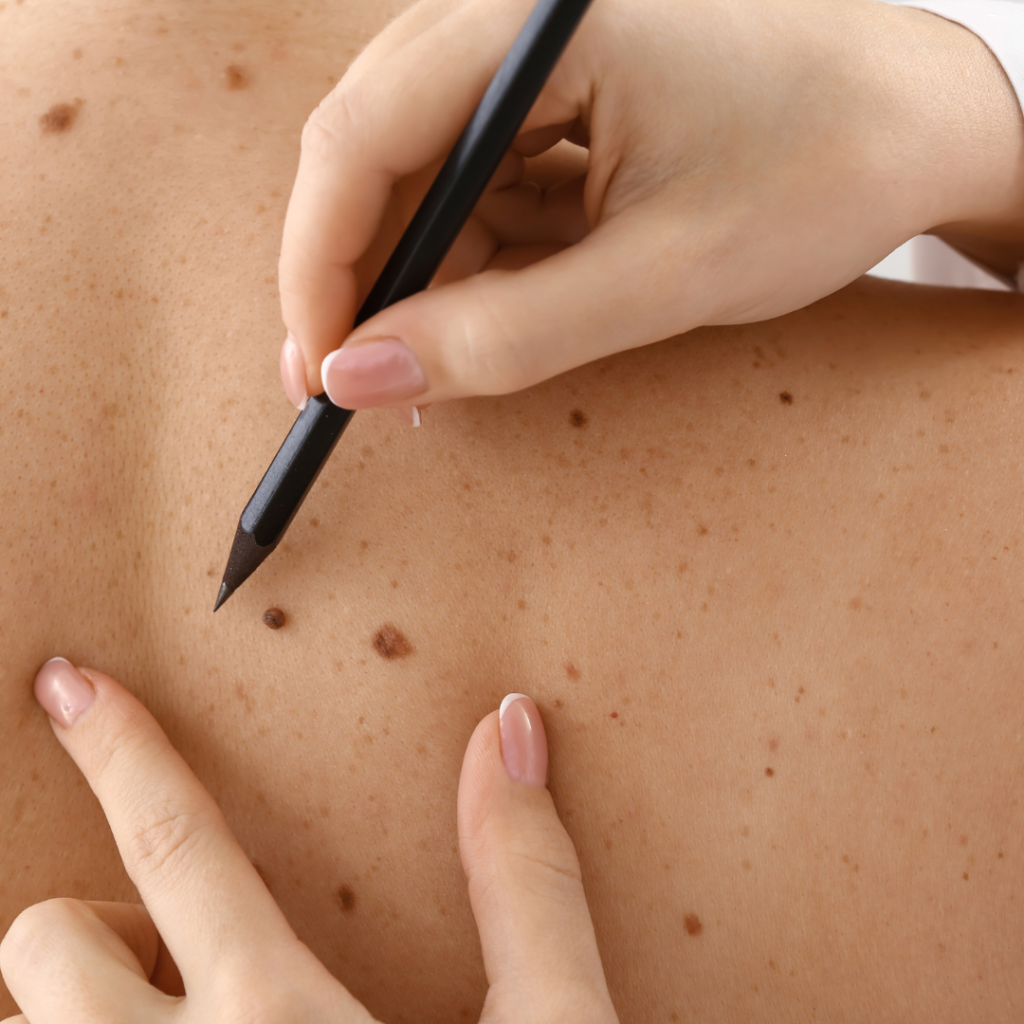 Mole getting checked on back during a skin check